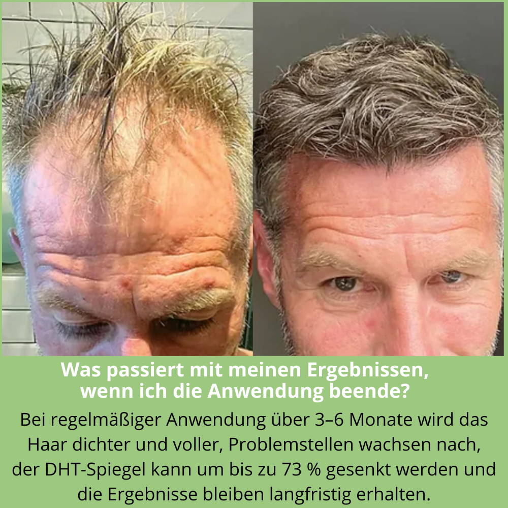 Hoegoa™ | Mikroinfusion zur Förderung des Haarwachstums für Männer und Frauen