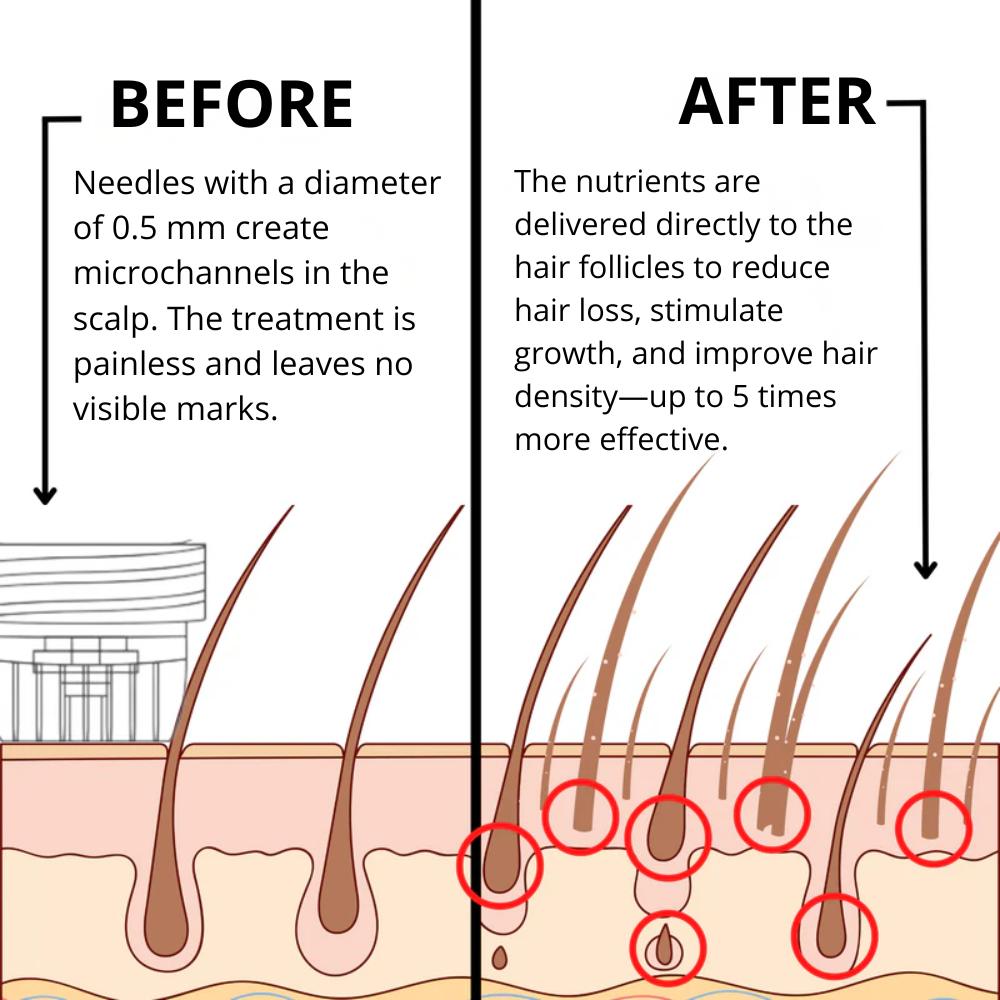 Hoegoa™ | Mikroinfusion zur Förderung des Haarwachstums für Männer und Frauen