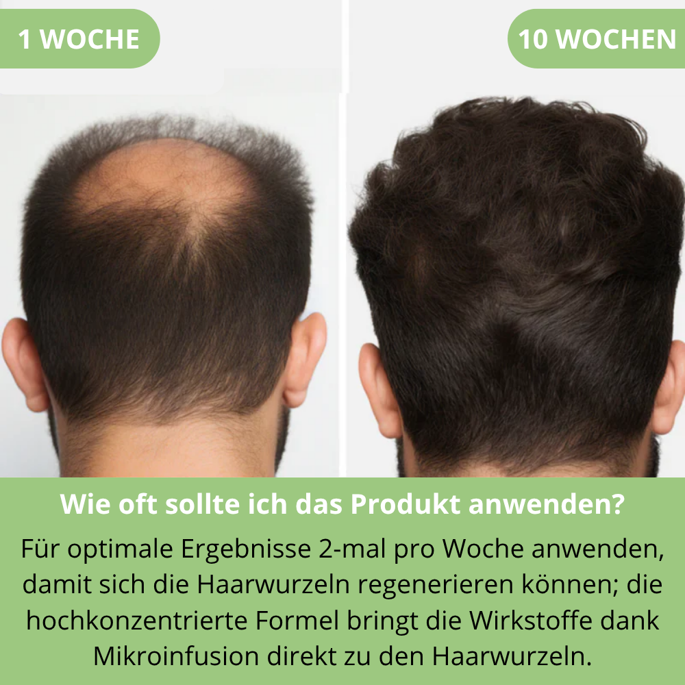 Hoegoa™ | Mikroinfusion zur Förderung des Haarwachstums für Männer und Frauen