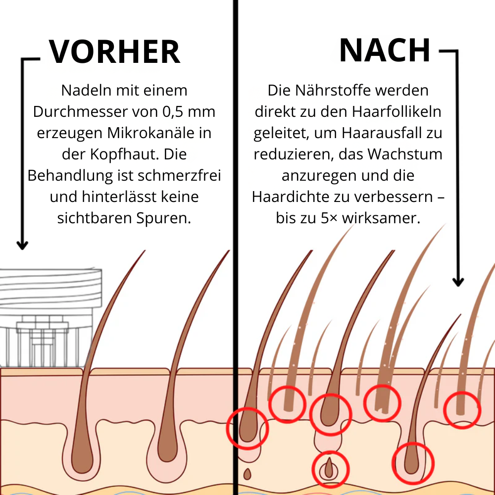 Hoegoa™ | Mikroinfusion zur Förderung des Haarwachstums für Männer und Frauen